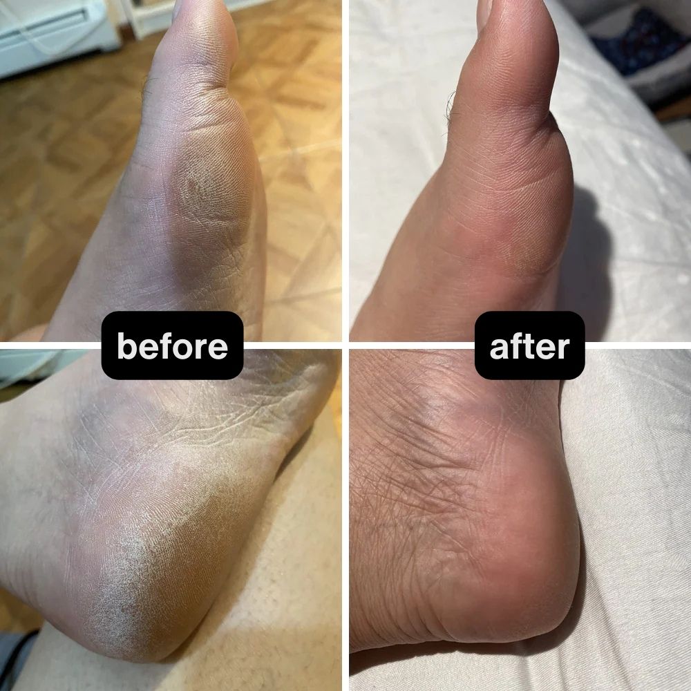 Prevents Cracked Heels & Foot Embarrassment