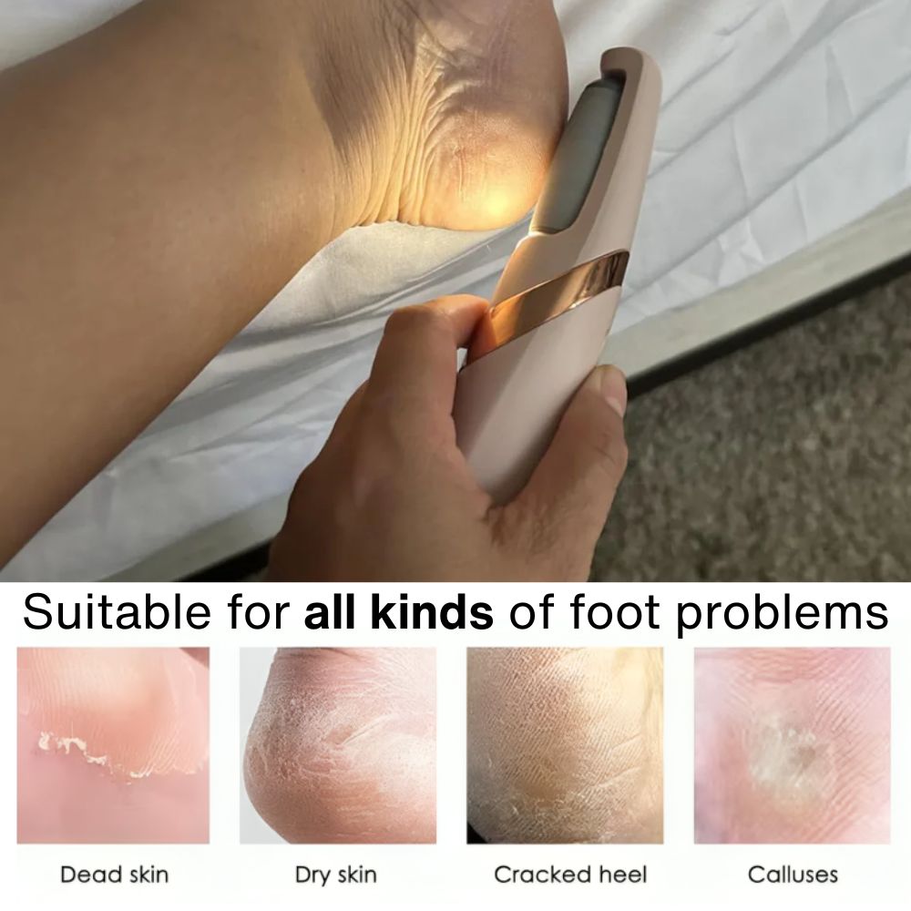 Prevents Cracked Heels & Foot Embarrassment